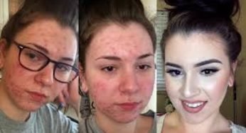 How To Treat Acne Disease / Acne Causes And Remedy