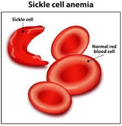 First Sickle Cell Patient gets cured