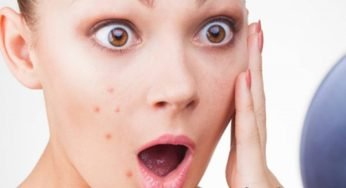 How To Remove Pimples – How To Get Rid Of Pimples Fast.